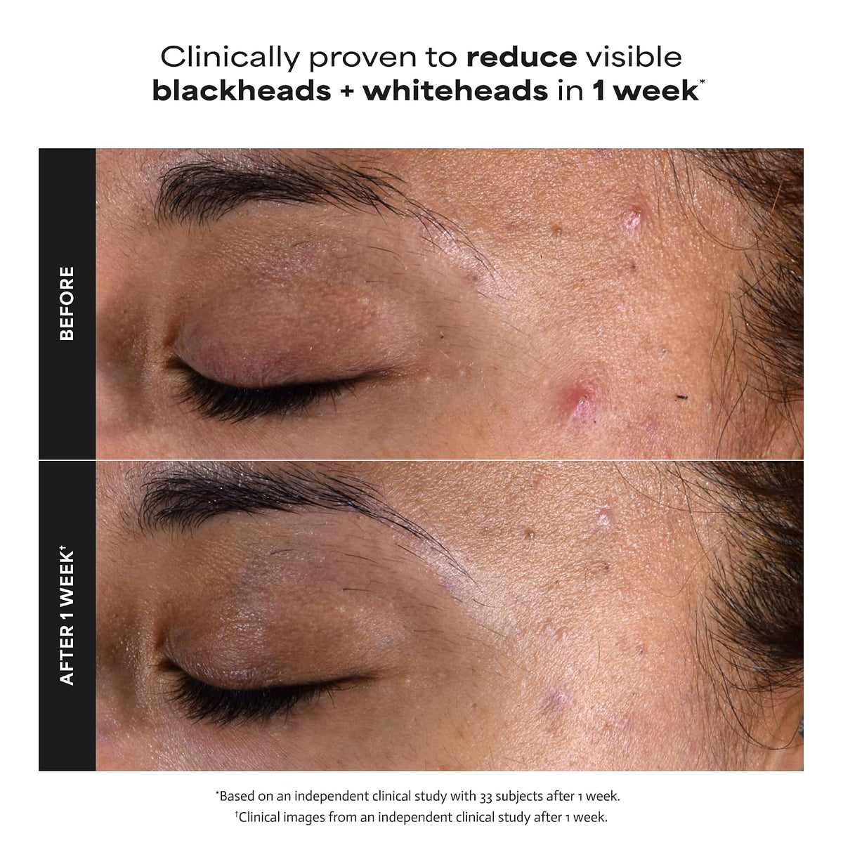 Paula's Choice SKIN PERFECTING 2% BHA Liquid Leave-On Exfoliant |