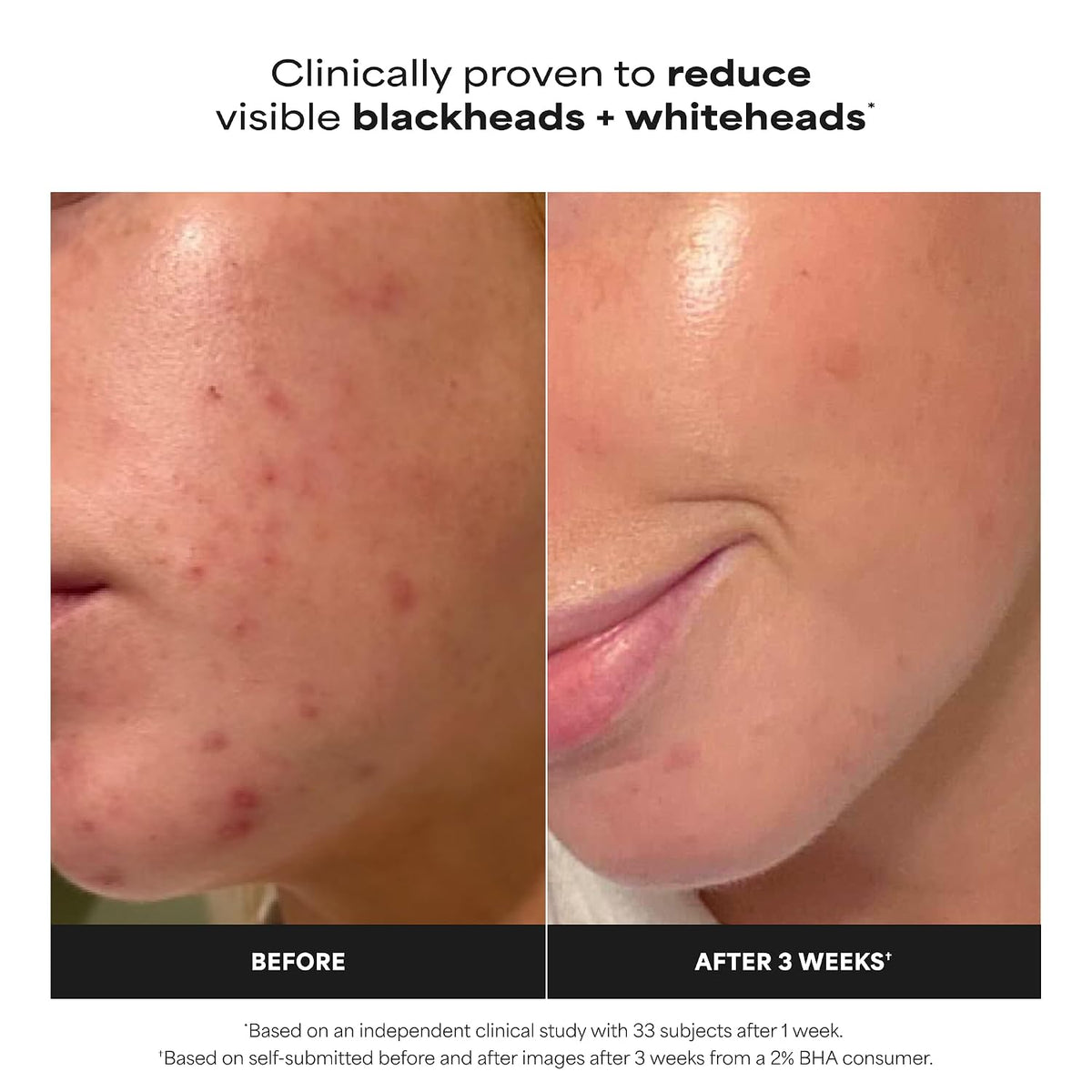 Paula's Choice SKIN PERFECTING 2% BHA Liquid Leave-On Exfoliant |