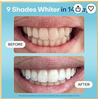 Lumineux Teeth Whitening Strips, Peroxide Free, 21 Treatments (3 Months)  (Use amazon link to purchase)